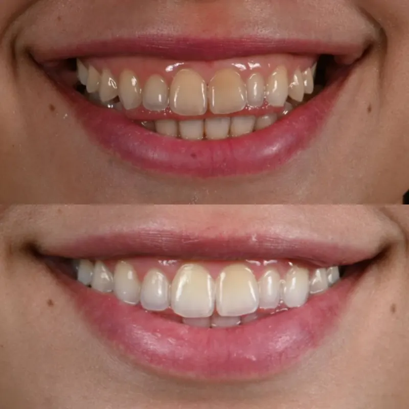 Antes y después de un blanqueamiento dental en Guayaquil