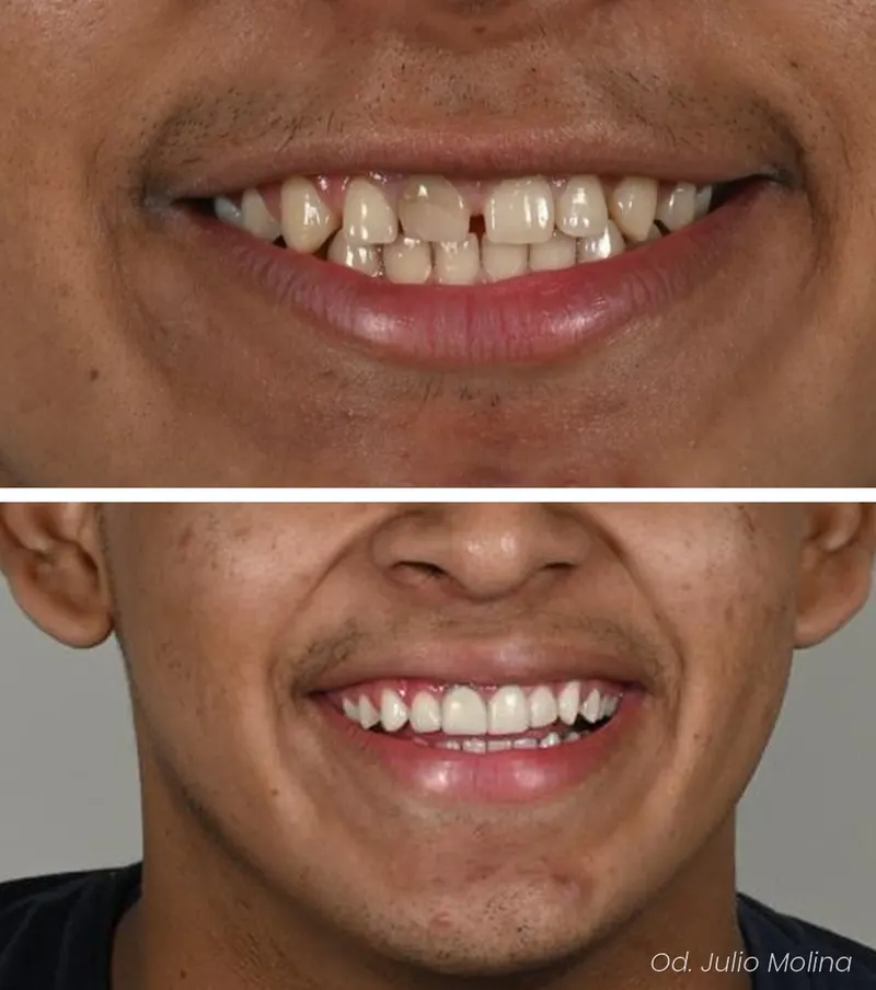 Antes y después de un tratamiento de estética dental realizado por el Dr. Julio Molina