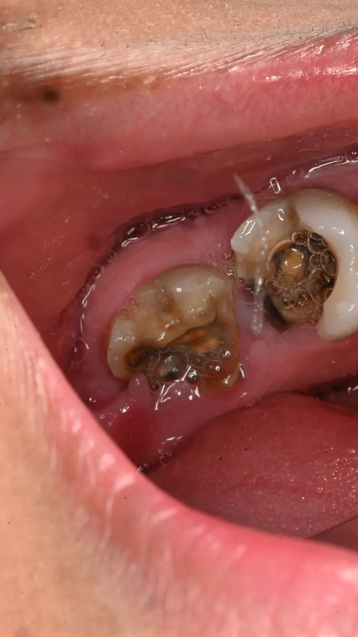 Molares con caries profunda antes del tratamiento conservador